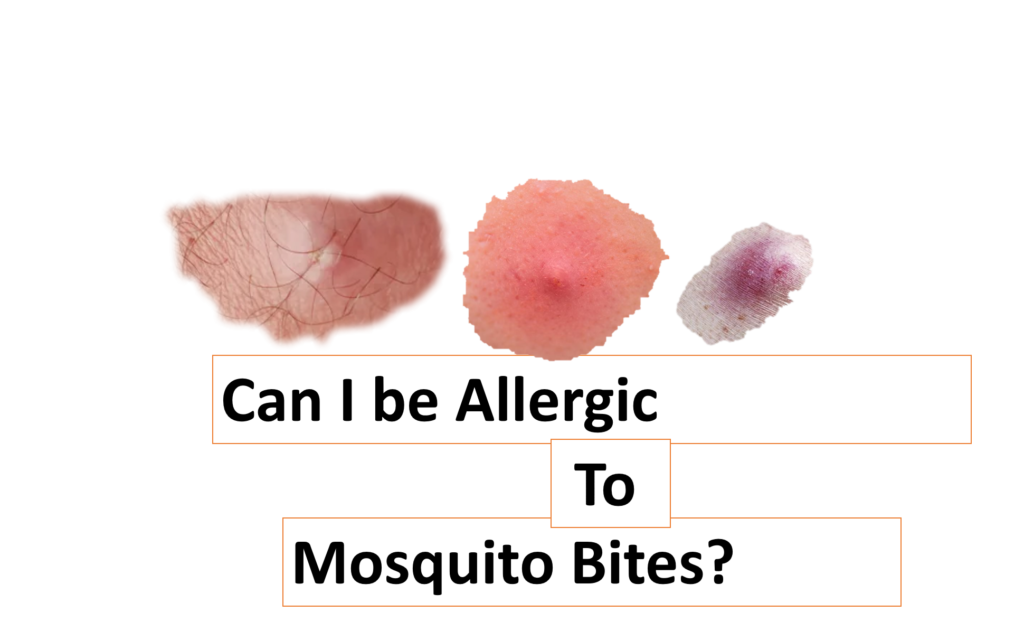 Can I be Allergic to Mosquito Bites?