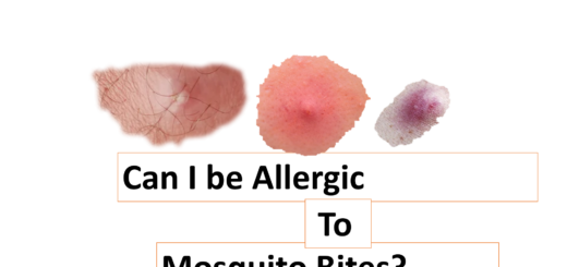 Can I be Allergic to Mosquito Bites?